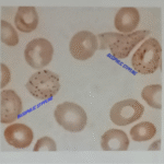 Basophilic Stipplings/Stippled rbc
