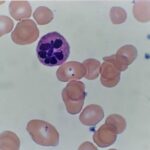 Hematology Case Studies-Megaloblastic Anemia