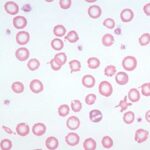 Normal RBC Mild hypochromia