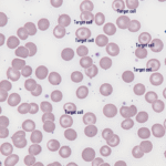 Hematology Case Studies-Target cells and microcytes