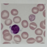 BASOPHILIC STIPPLINGS