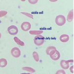 Sickled rbc with howell-jolly body