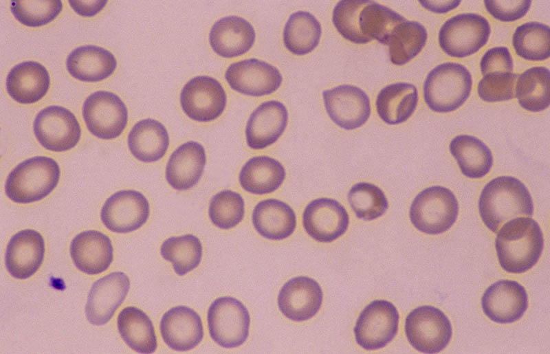 Severe Iron deficiency anemia