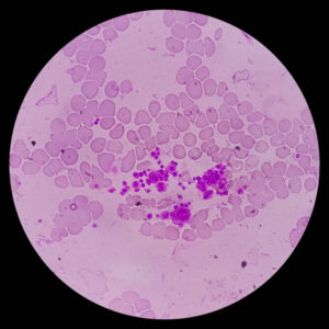 Severe Anemia Case Study