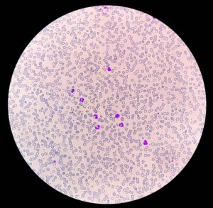 Severe Anemia Case Study