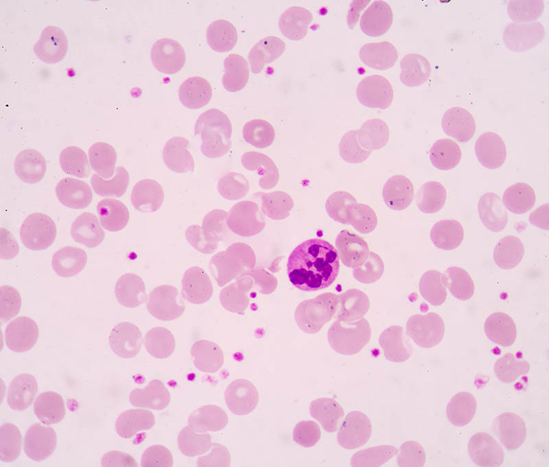 hypersegmented neutrophils.2
