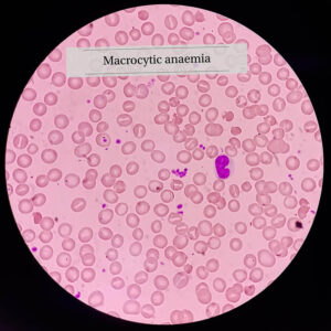 macrocytic aneimia folic acid vitB12 def