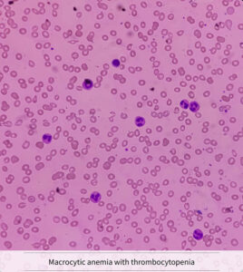 macrocytic anemia with thrombocytopenia